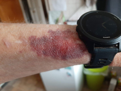 Blood Blister