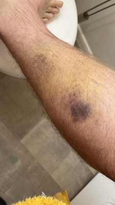 Grade 2 Calf tear