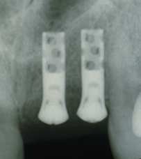 straumann-hollow-cylinder-image-6621-3286b5.jpeg